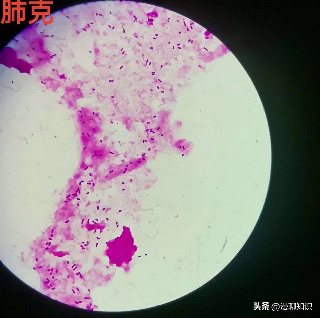 老年人得了肺炎应如何有效医治,肺炎有多严重怎么办