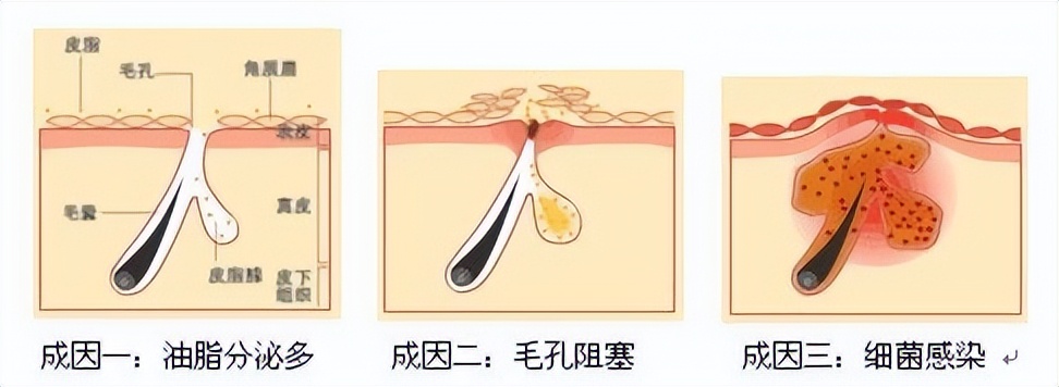 手臂毛孔堵塞怎么疏通最快最好,毛孔堵塞用什么药物可以疏通