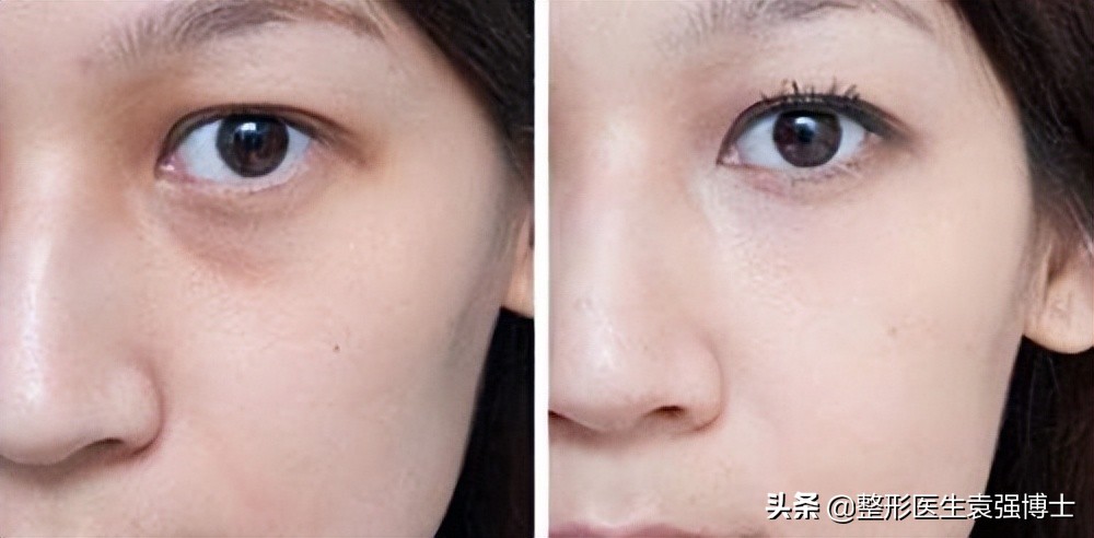 祛眼袋手术的真相,眼袋去除手术真实案例