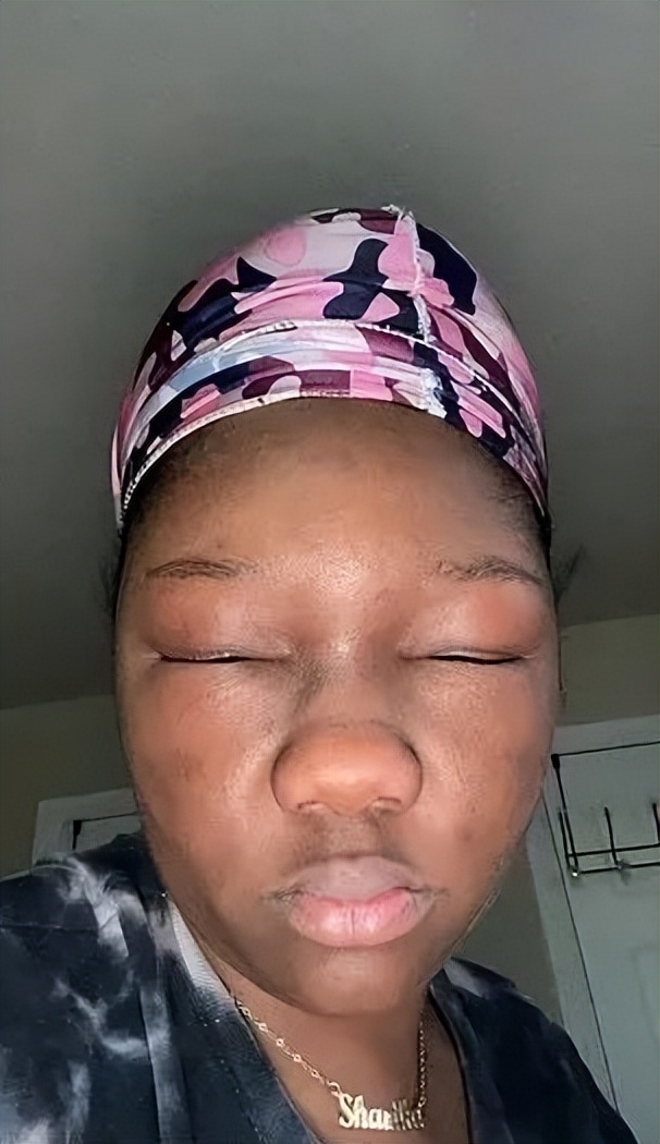 美国妹子染头发过敏全脸肿成emoji，不光失明还险些窒息