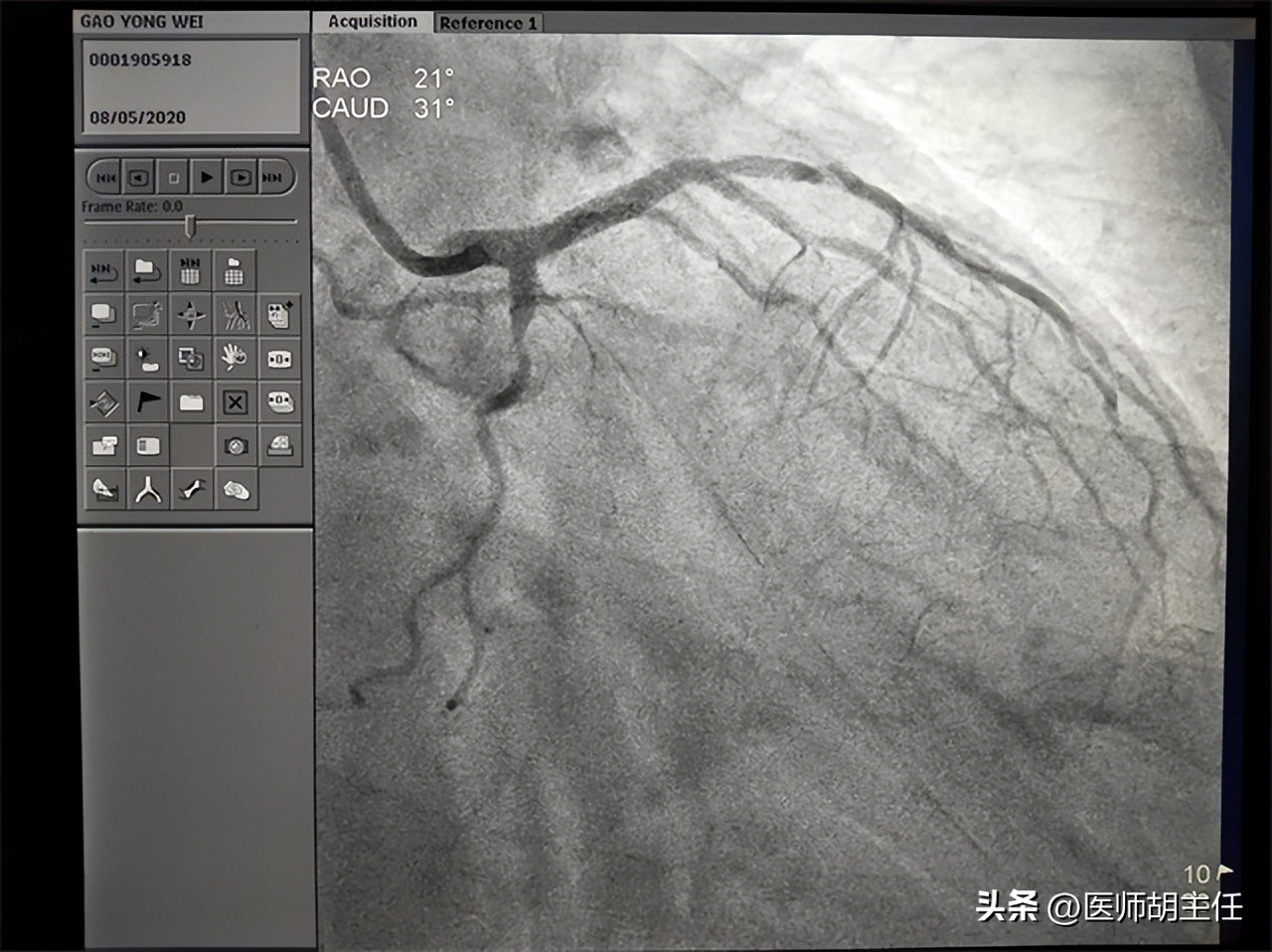 做冠状动脉造影对人体有副作用吗,做完冠脉造影后血管会变脆吗