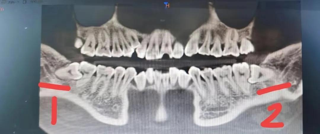 拔完智齿有一个洞怎么处理,拔完智齿没缝有个很大的洞怎么办