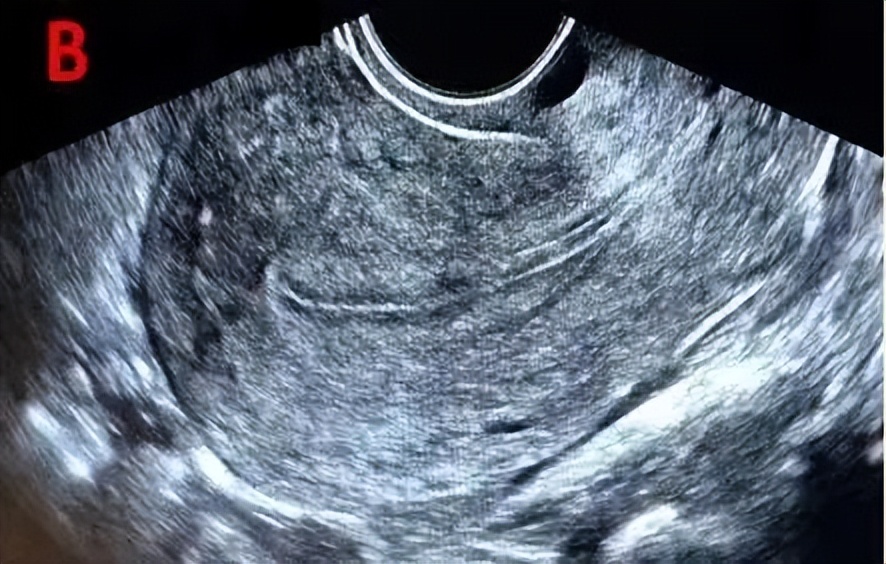 助您好孕——B超监测排卵不可不知道的细节