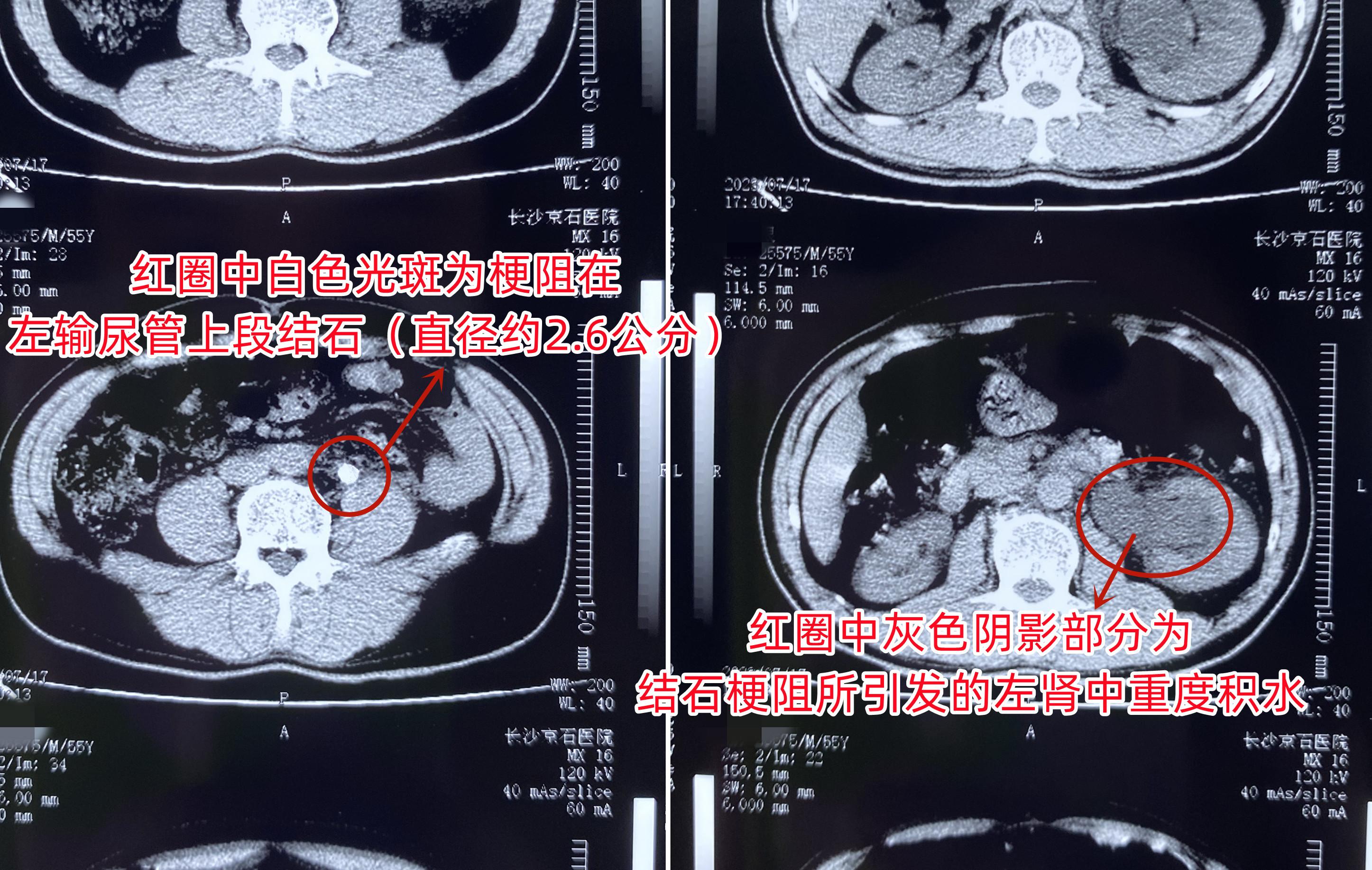 男子医院诊断中暑,浙江男子以为自己中暑