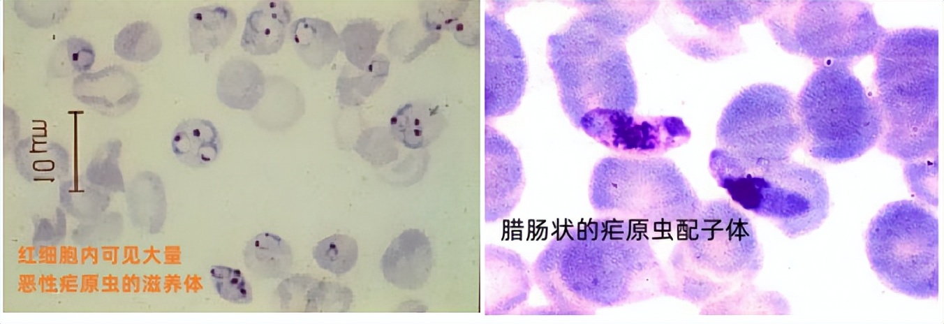 如果同时得了几种寄生虫病怎么治,现在寄生虫有哪些