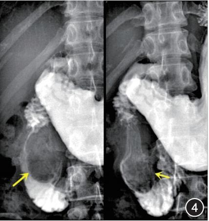 以急性胰腺炎为首发表现的成人十二指肠囊性重复畸形1例