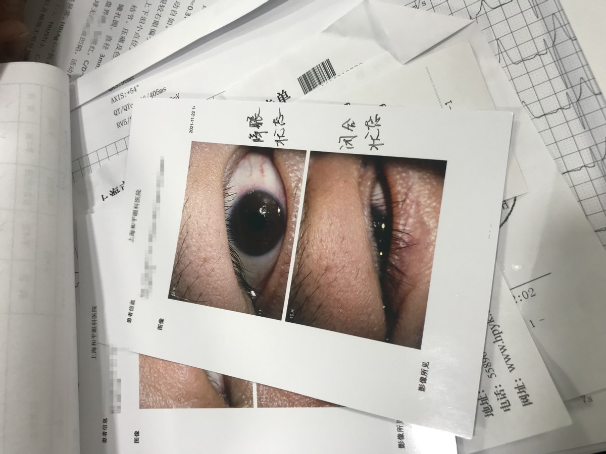 长期睁着眼睛睡觉，对身体有害会致盲？医生建议需牢记