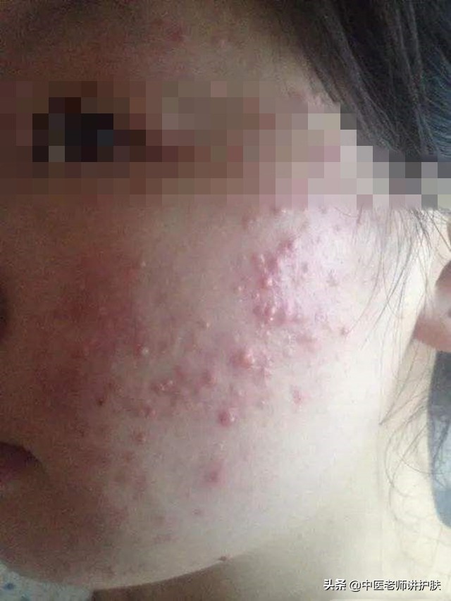 激素依赖性皮炎的发病机制,什么是激素依赖性皮炎怎么治疗