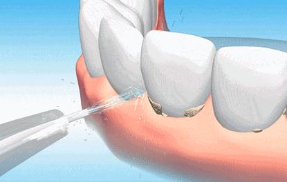 冲牙器和电动牙刷哪个效果好视频,电动牙刷冲牙器对比