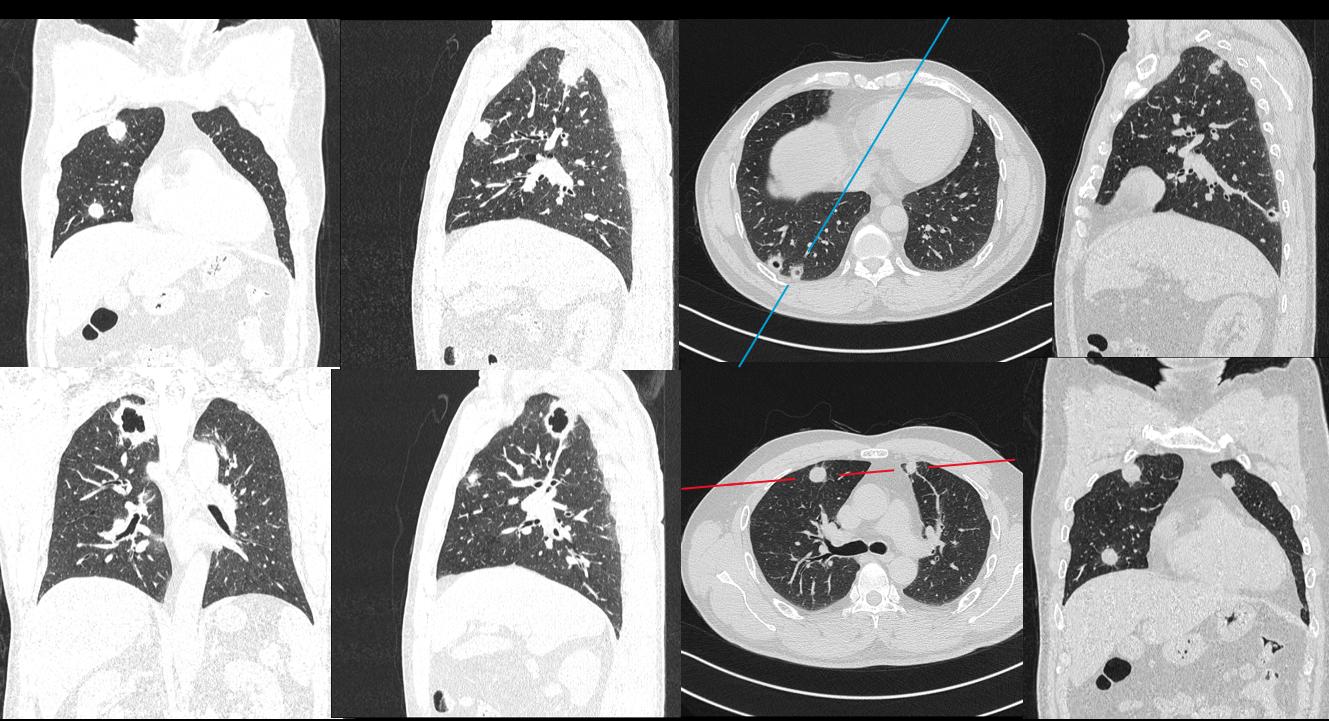 肉芽肿性血管炎ct表现,嗜酸性肉芽肿性血管炎症状