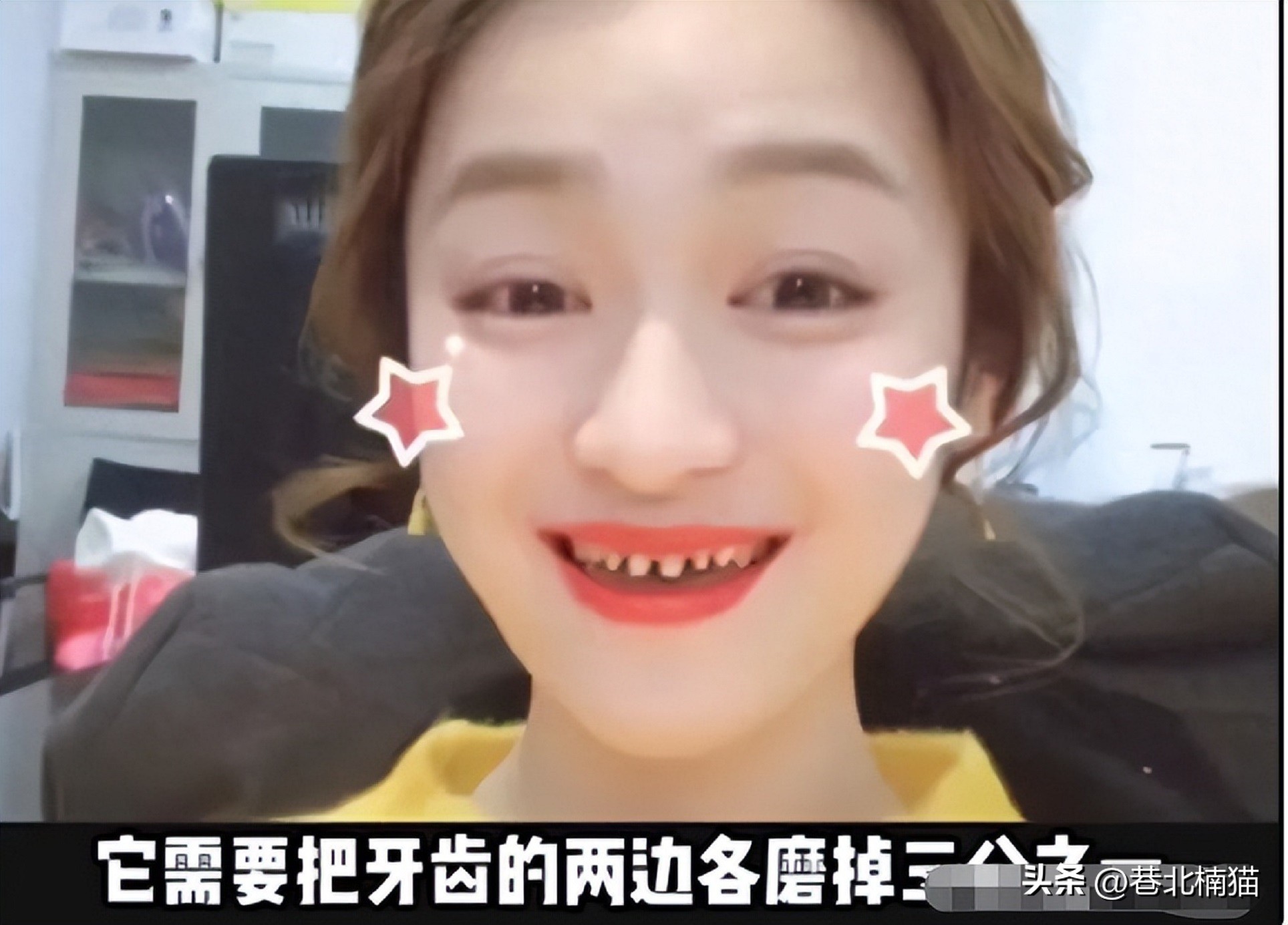 明星嘴突戴牙套前后对比,明星和假牙