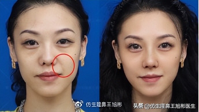 鼻基底填充会移位到鼻孔吗,鼻基底填充假体会拉长人中吗