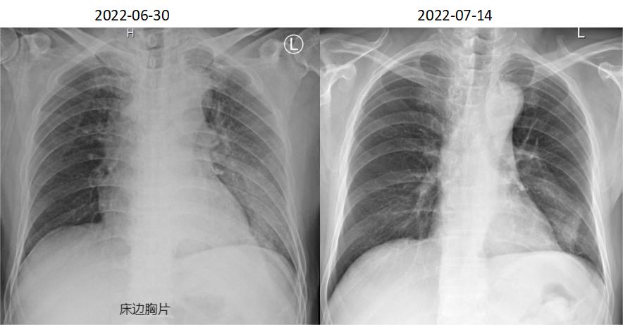 发热十多天了输液吃药还是发热,脓毒症高烧不退