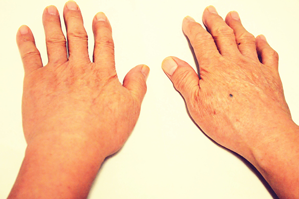 尿酸偏高者可以食豆类食物吗,尿酸偏高可以吃杂粮和豆类吗