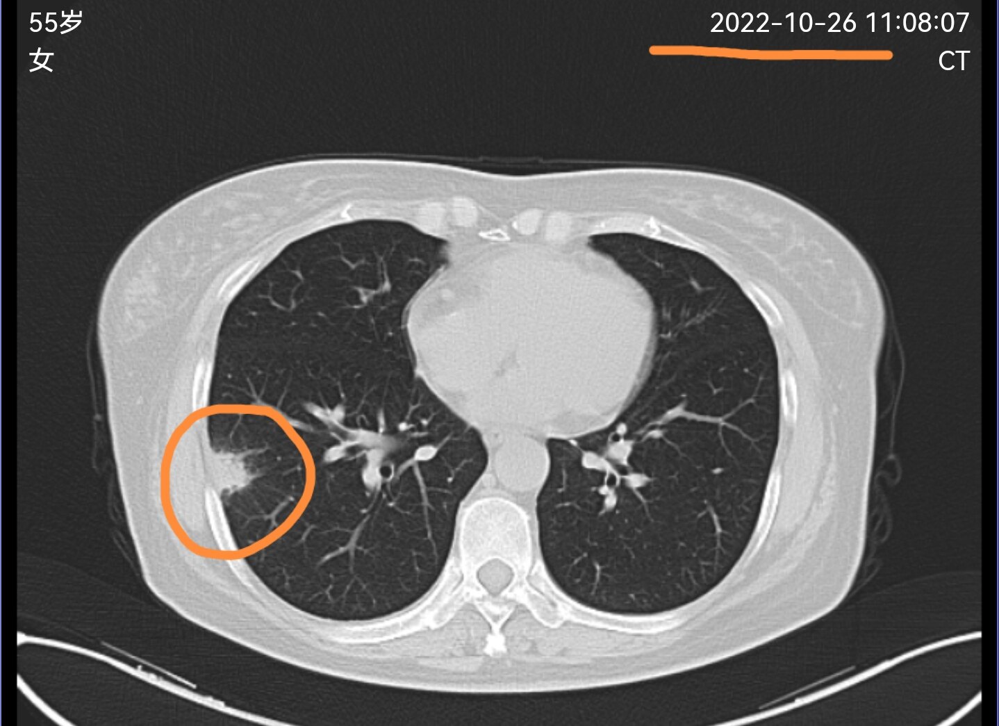 刘懿博士说肺癌全集,刘懿博士说肺癌毛玻璃结节