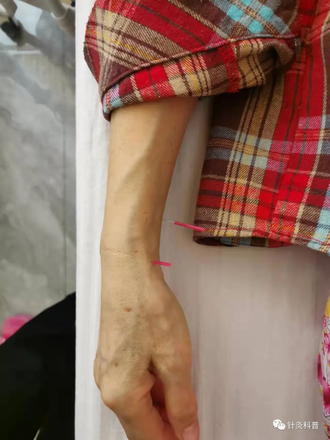 脉诊针灸穴位,董氏针灸治疗青光眼处方