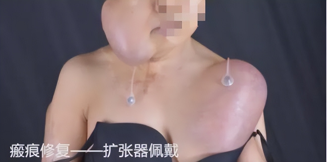 16岁女孩拒绝官二代求爱被毁容,拒绝富二代追求遭毁容以前照片