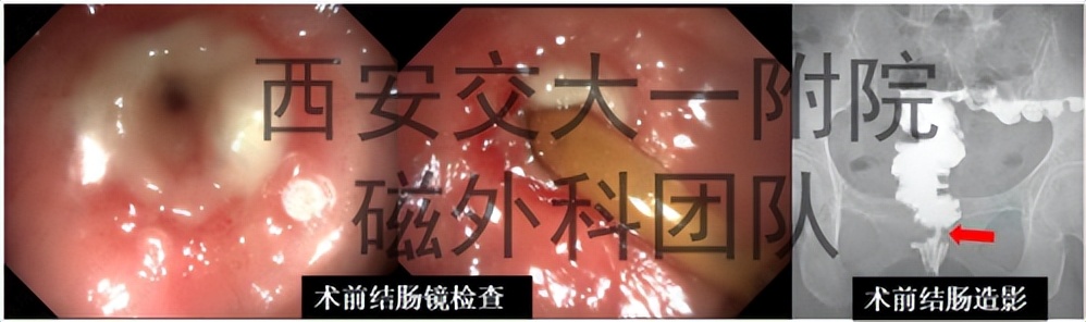 “小磁环”巧解大难题西安交大一附院应用S形磁环治疗直肠狭窄