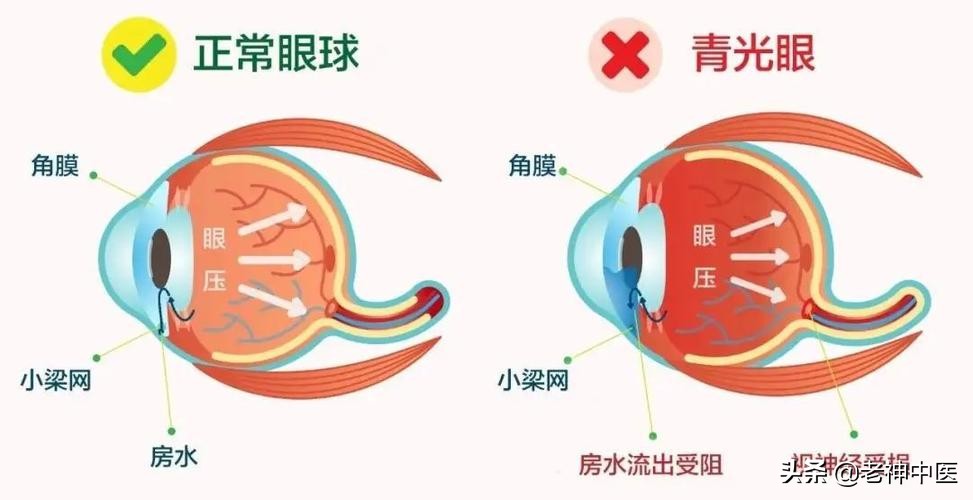 糖尿病视网膜病变眼底出血严重吗,糖尿病眼底出血黄斑病变怎么治