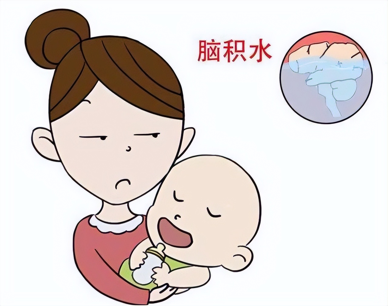 先天性脑积水能坚持多久,成人先天脑积水有必要治疗吗