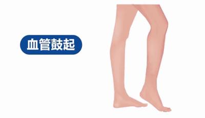 静脉曲张重要通知,静脉曲张优惠活动