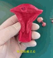 不同的子宫肌瘤都长啥样？看医生如何切除