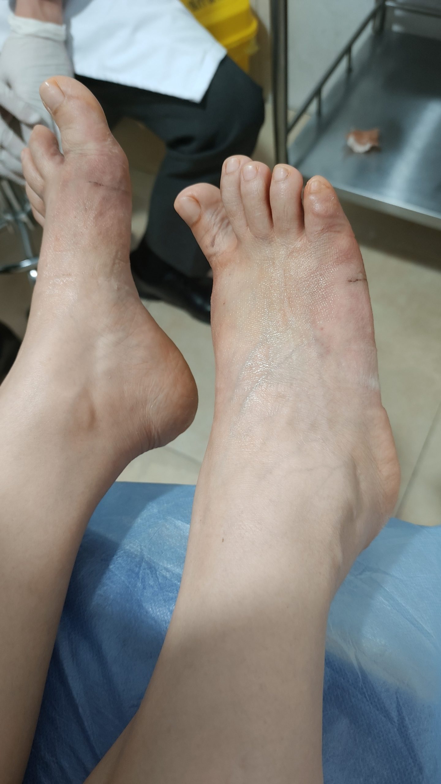 小脚趾外侧凸起怎么办？裁缝趾的手术矫正