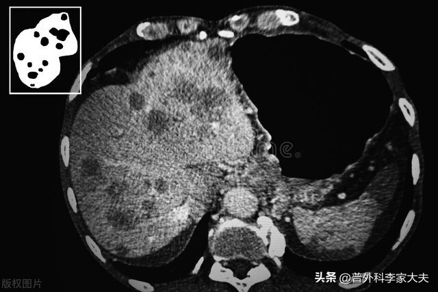 肝癌靶向治疗是怎么治疗,肝癌靶向药物治疗能达到什么效果