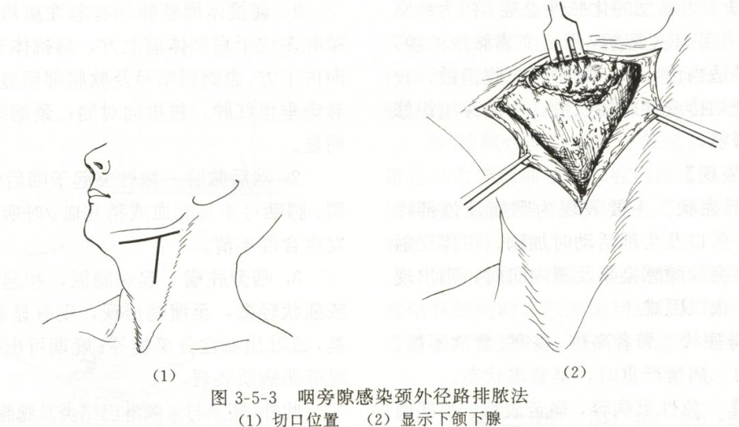 咽喉脓肿临床表现,咽旁脓肿临床表现与治疗