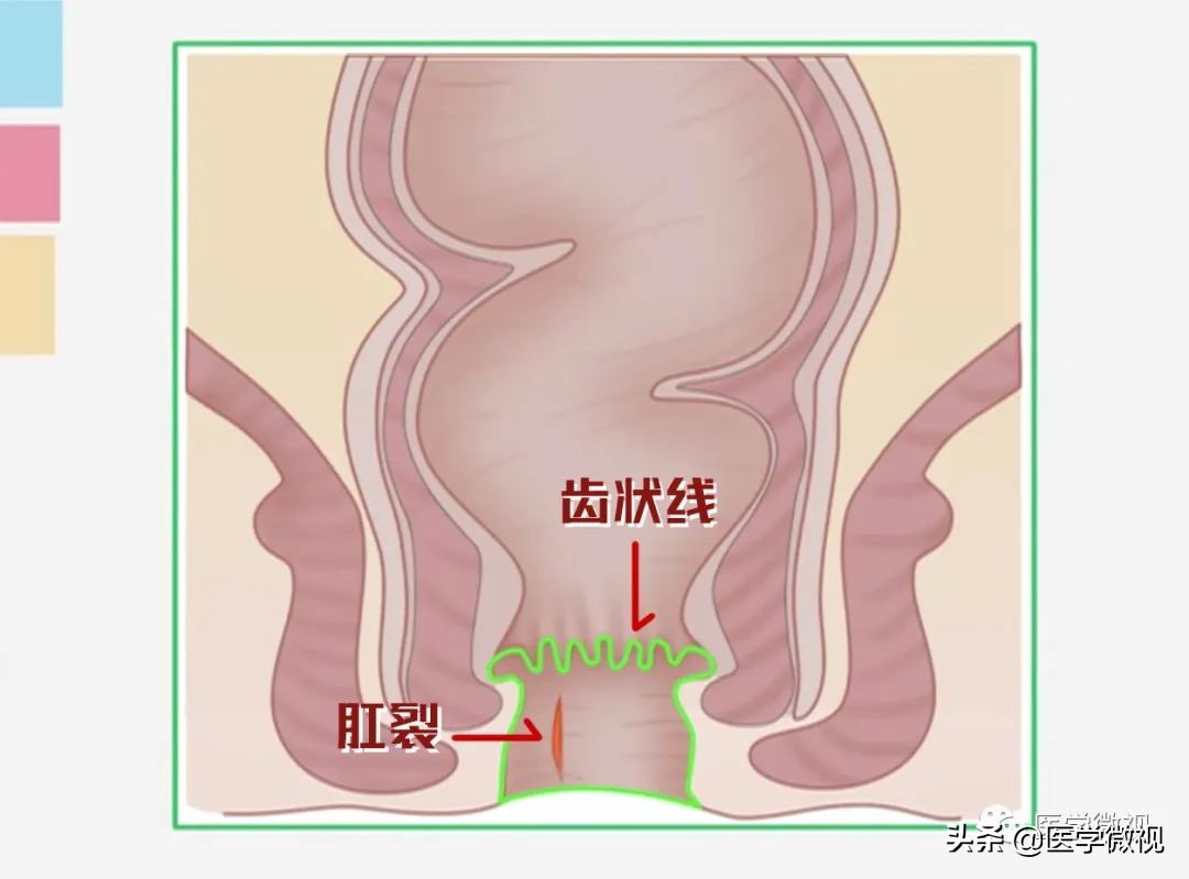 便血是痔疮还是肛裂？主要看这个症状