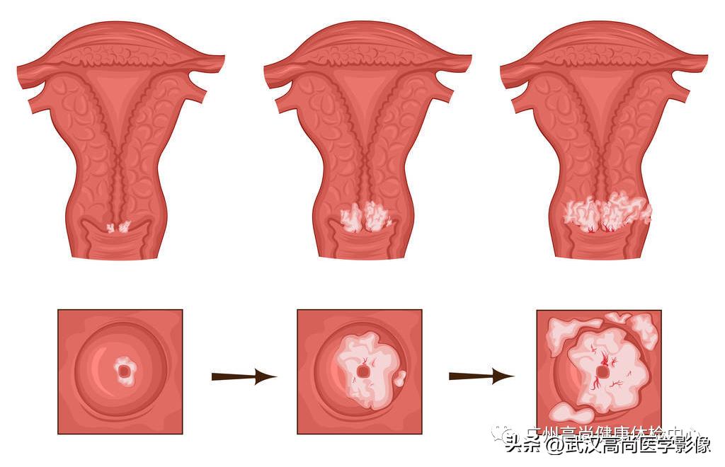 宫颈癌筛查为女性健康保驾护航,宫颈癌是可以早期筛查和预防的