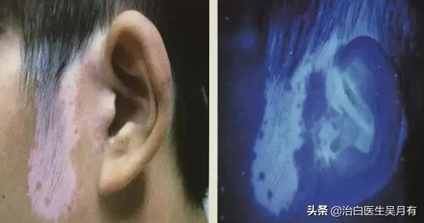 白癜风白斑会在好转的同时发展吗,白癜风白斑不扩散了就算是好了吗