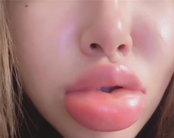 女生吃田螺有什么危害,女孩嗦田螺肿成香肠嘴