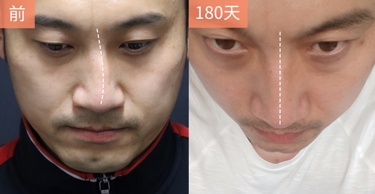 歪鼻整形,类型不同方法不同,看看自己的“歪鼻子”对照了解!