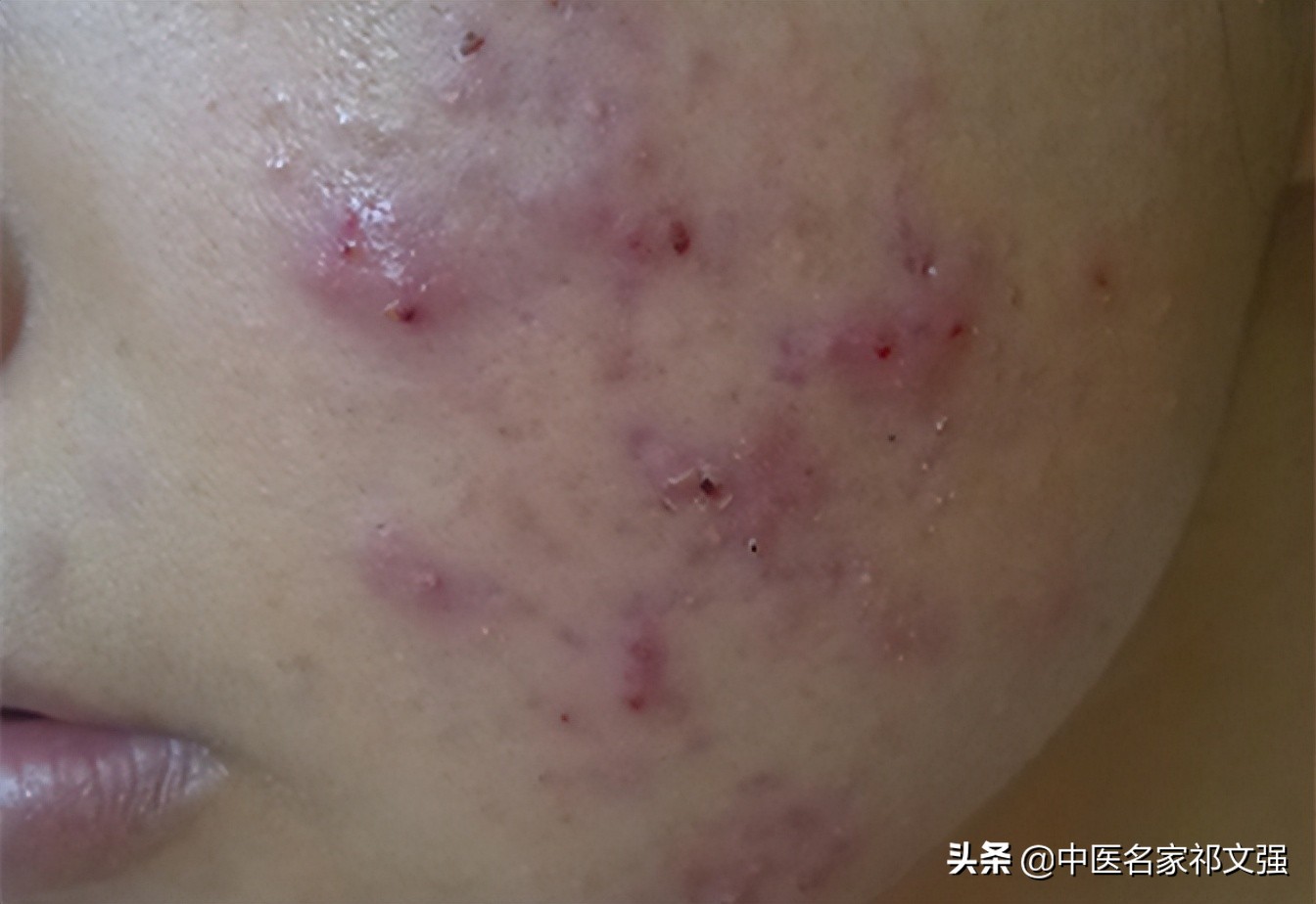 青少年痤疮最佳治疗药物,青少年痤疮用什么中药治疗