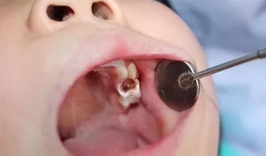 拔牙麻药对人体伤害有多大,牙齿整形需要拔牙伤害身体吗