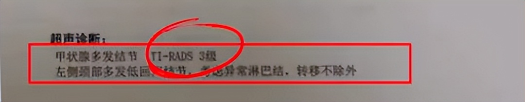 中医实战笔记甲状腺结节经方治疗,甲状腺结节钙化4b可以中医治疗吗