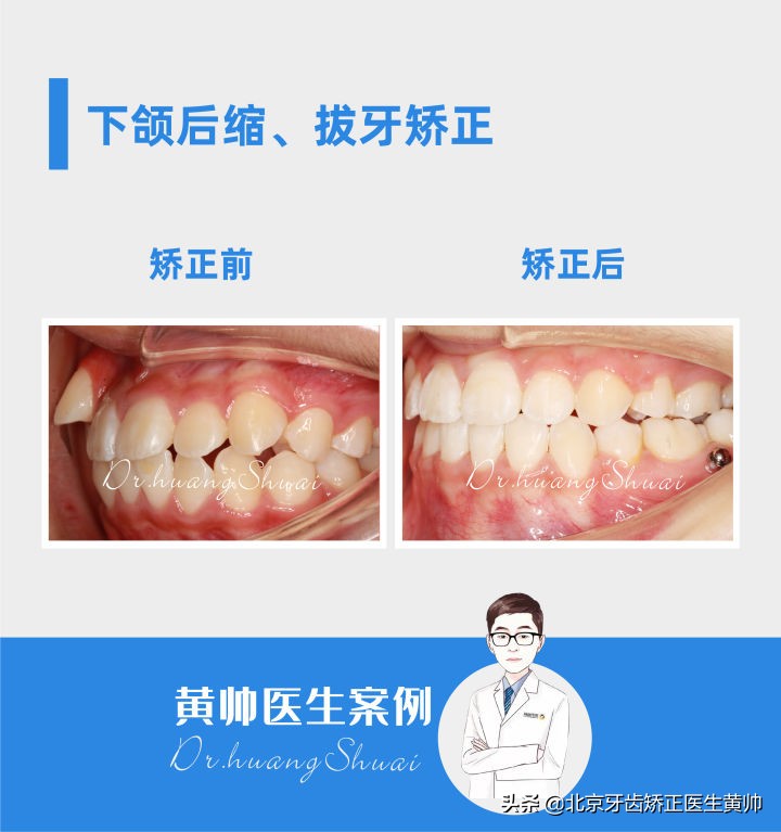 嘴凸的人怎么笑起来好看,嘴凸怎么让自己不焦虑