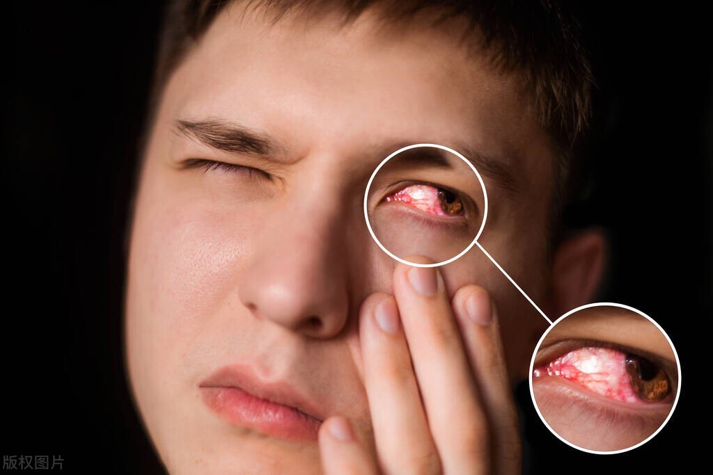 眼睛肿了，还有黄色的液体伴着血液流出来，究竟是怎么回事？