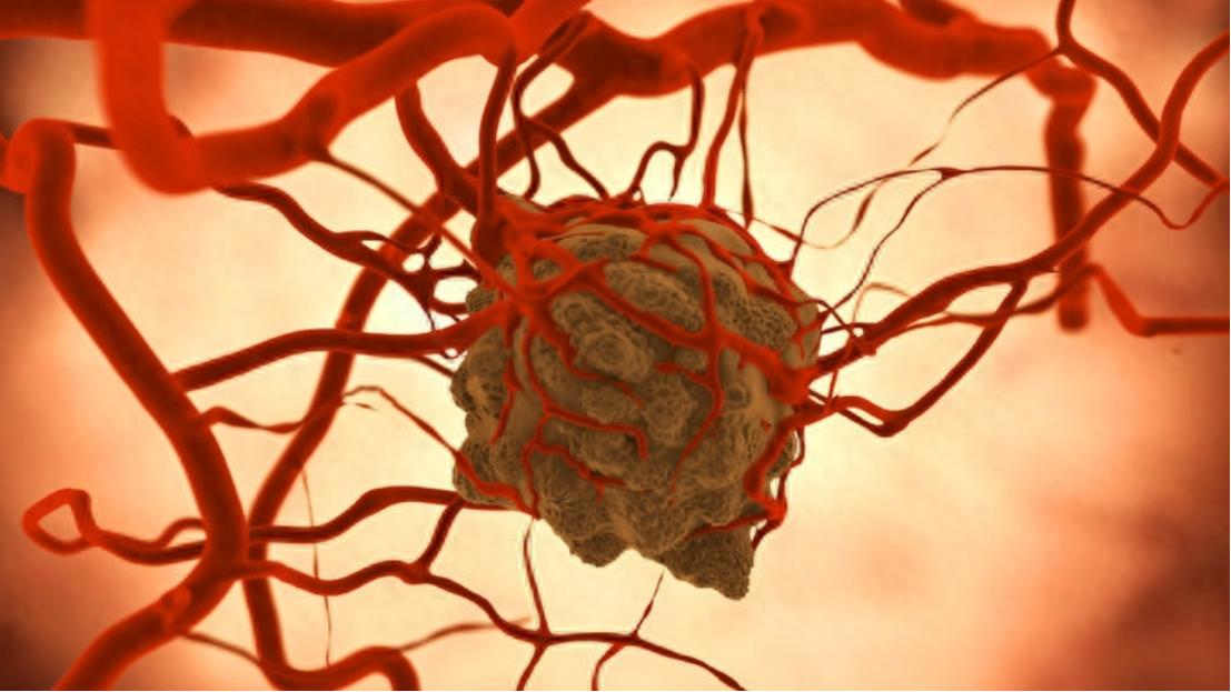 高温治疗是否可以杀死癌细胞,高温杀死癌细胞吗是真的吗