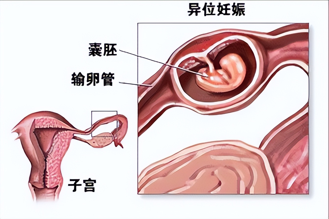 意外怀孕多久做无痛人流手术,怀孕36天无痛人流真实经历