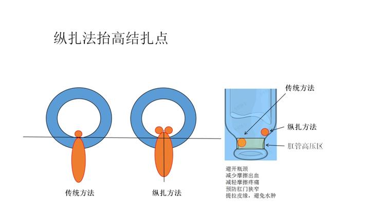 痔疮经久不愈用什么药,久痔如何治疗