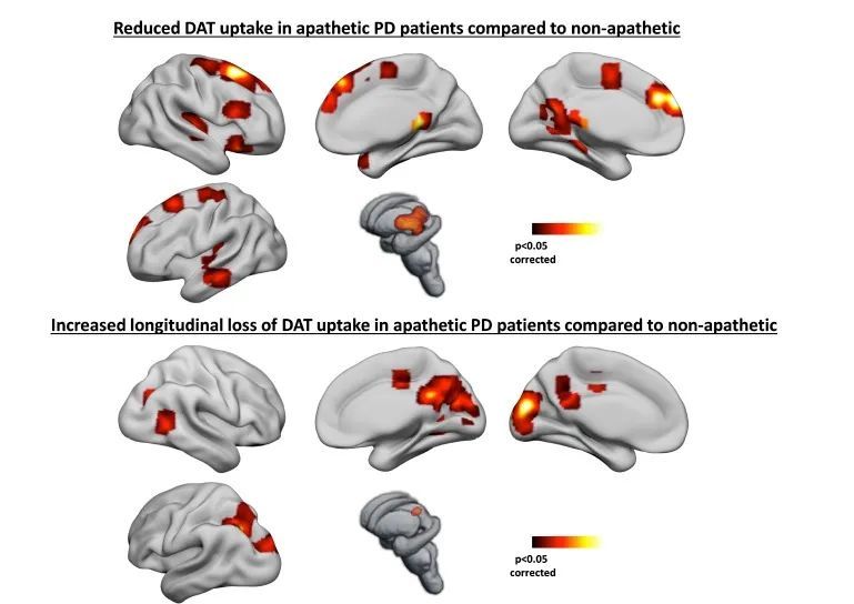 世界帕金森病日第28个主题,世界帕金森病日完整版