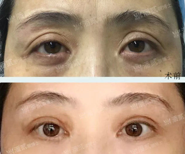 眼窝凹陷是什么症状,眼窝凹陷的改善方法有哪些