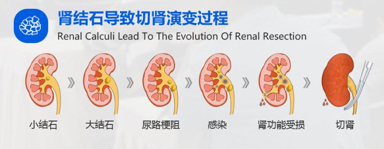 肾结石的自白书：我是肾结石，这是我兴风作浪的一生