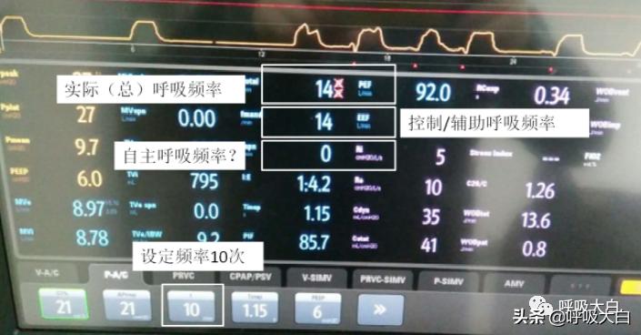 呼吸机设置：呼吸频率+吸呼比
