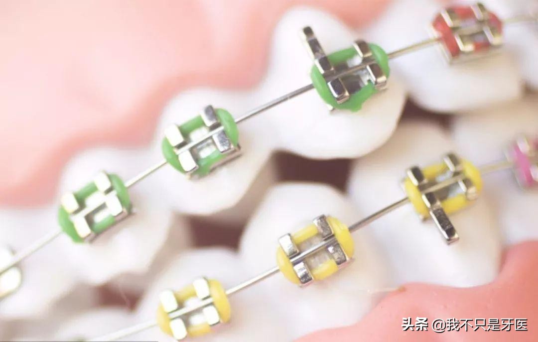 为什么二次口腔正畸矫正会有难度,矫正牙齿怎么选择正畸医生不被坑
