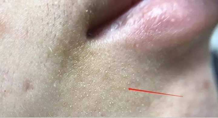 超微小气泡美容有用吗,美容院小气泡