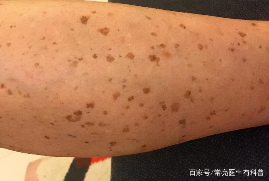 老人为什么脸上有老人斑,老年斑红霉素