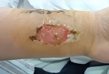 放疗皮肤护理健康宣教,放疗患者皮肤反应分类和护理